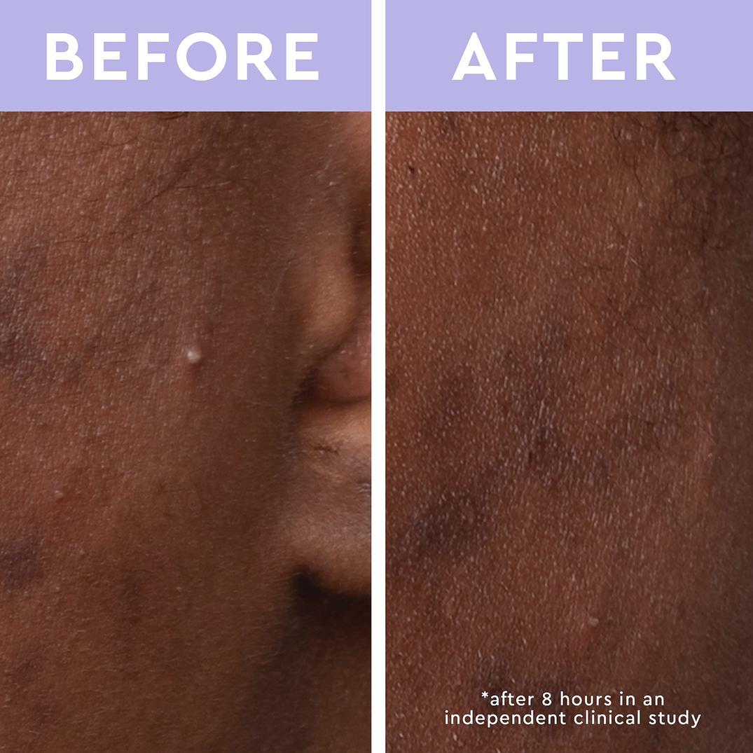 florence by mills Spot a Spot Acne Patches