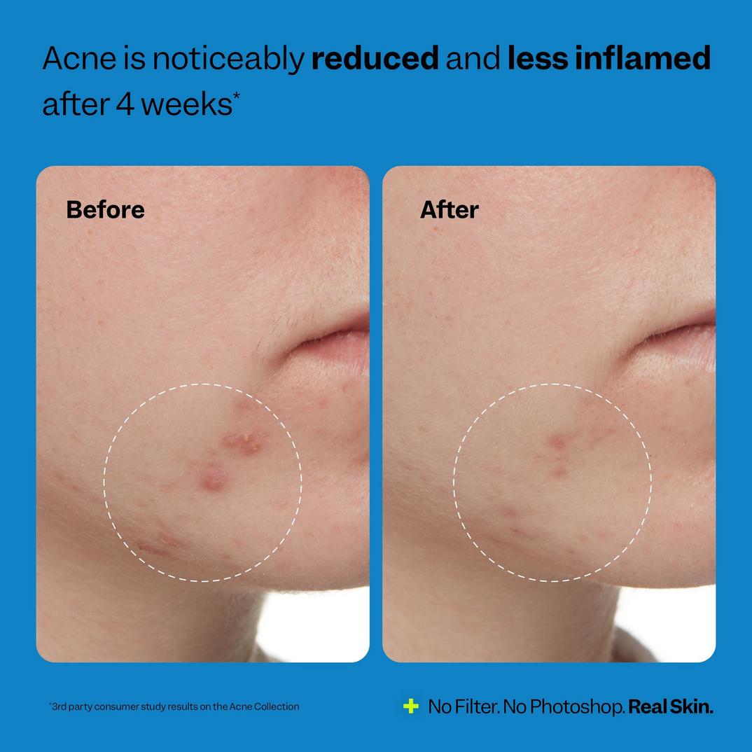 Peach Slices Acne Exfoliating Toner