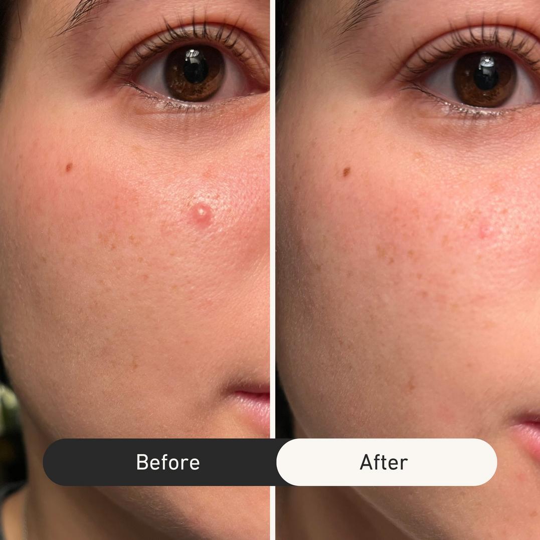 good light Luna Fast Acting Pimple Patches