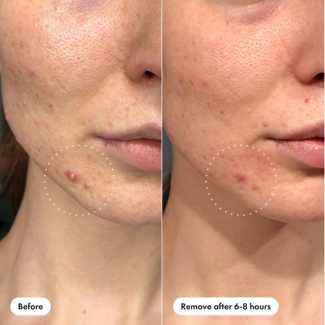 Hero Cosmetics Mighty Patch Invisible+ Daytime Hydrocolloid Acne Pimple Patches