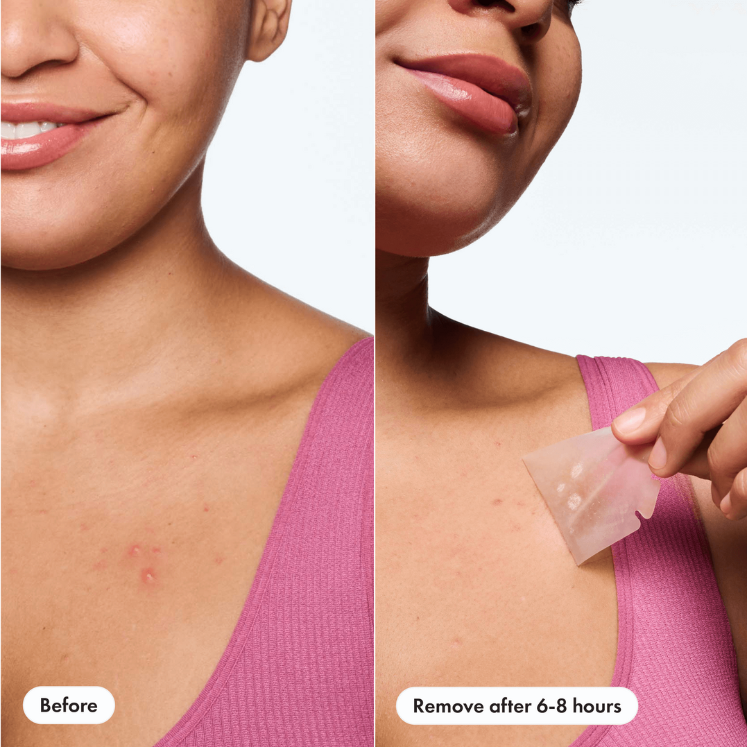 Hero Cosmetics Mighty Patch Body Acne Pimple Patches