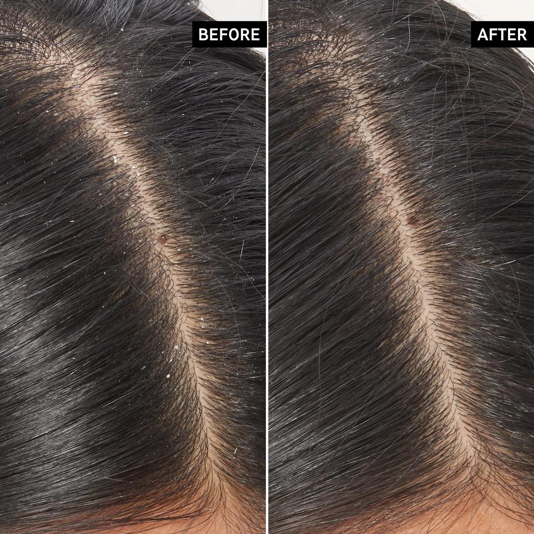 The INKEY List Salicylic Acid Exfoliating Scalp Treatment, detail