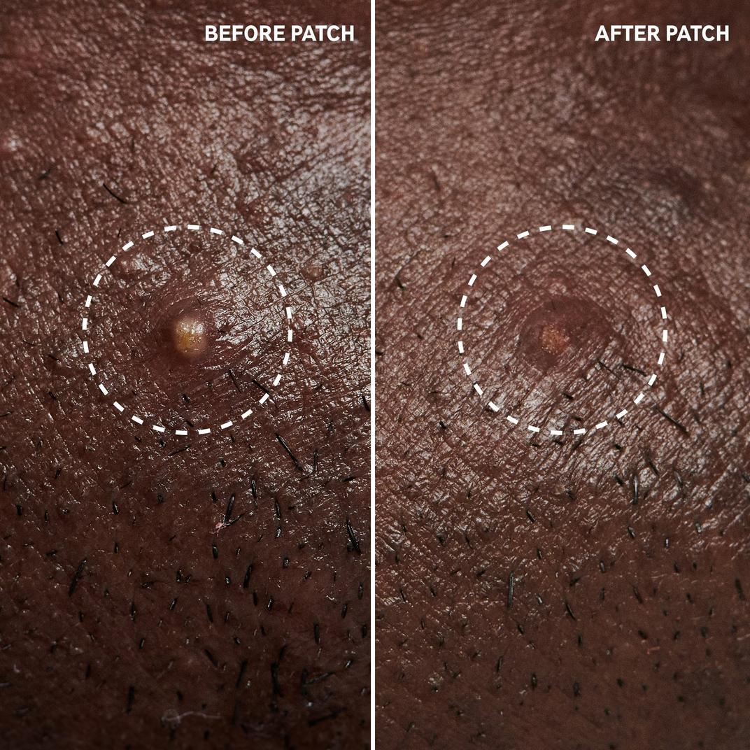 The INKEY List Hydrocolloid Invisible Pimple Patches + Salicylic Acid