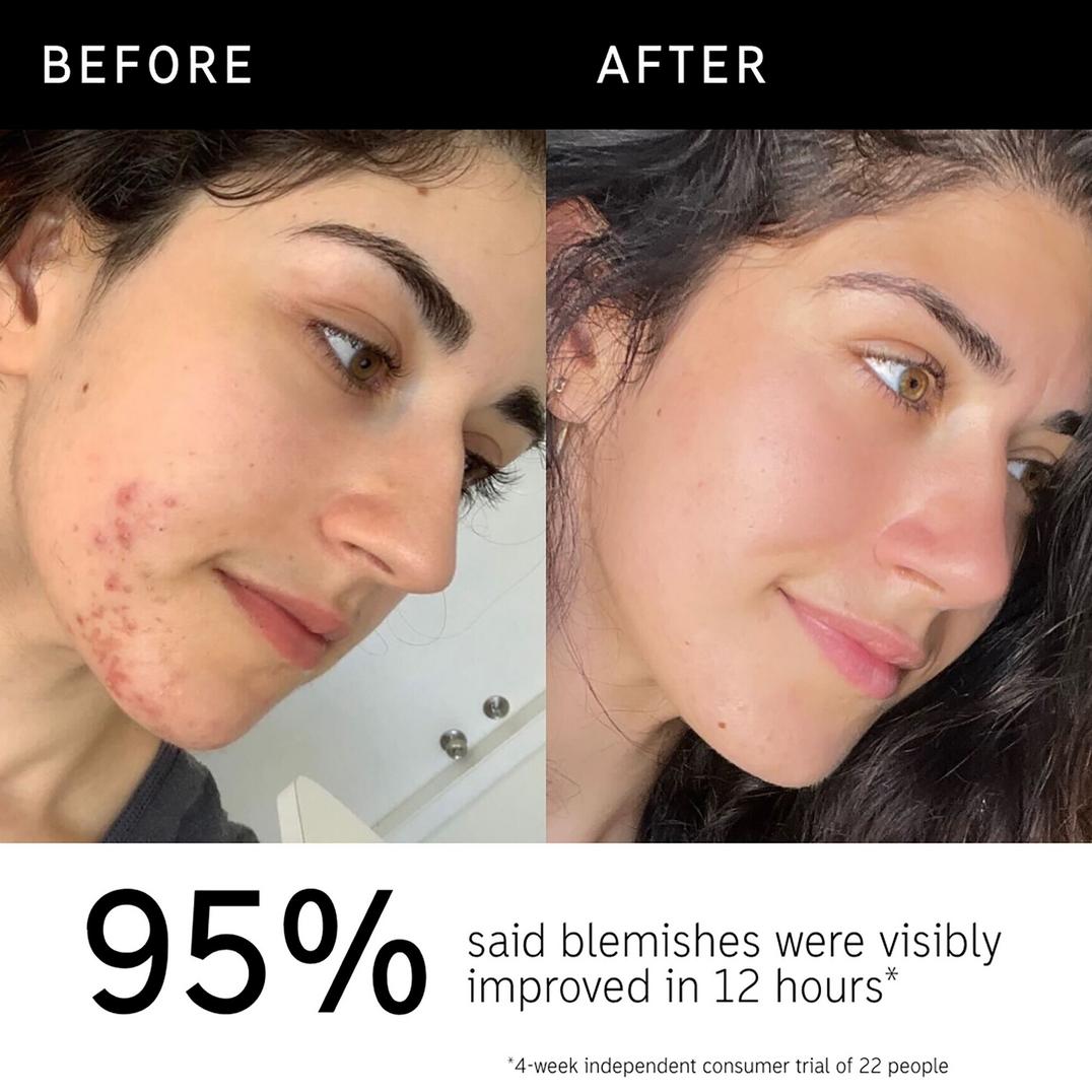 The INKEY List Succinic Acid Acne Treatment