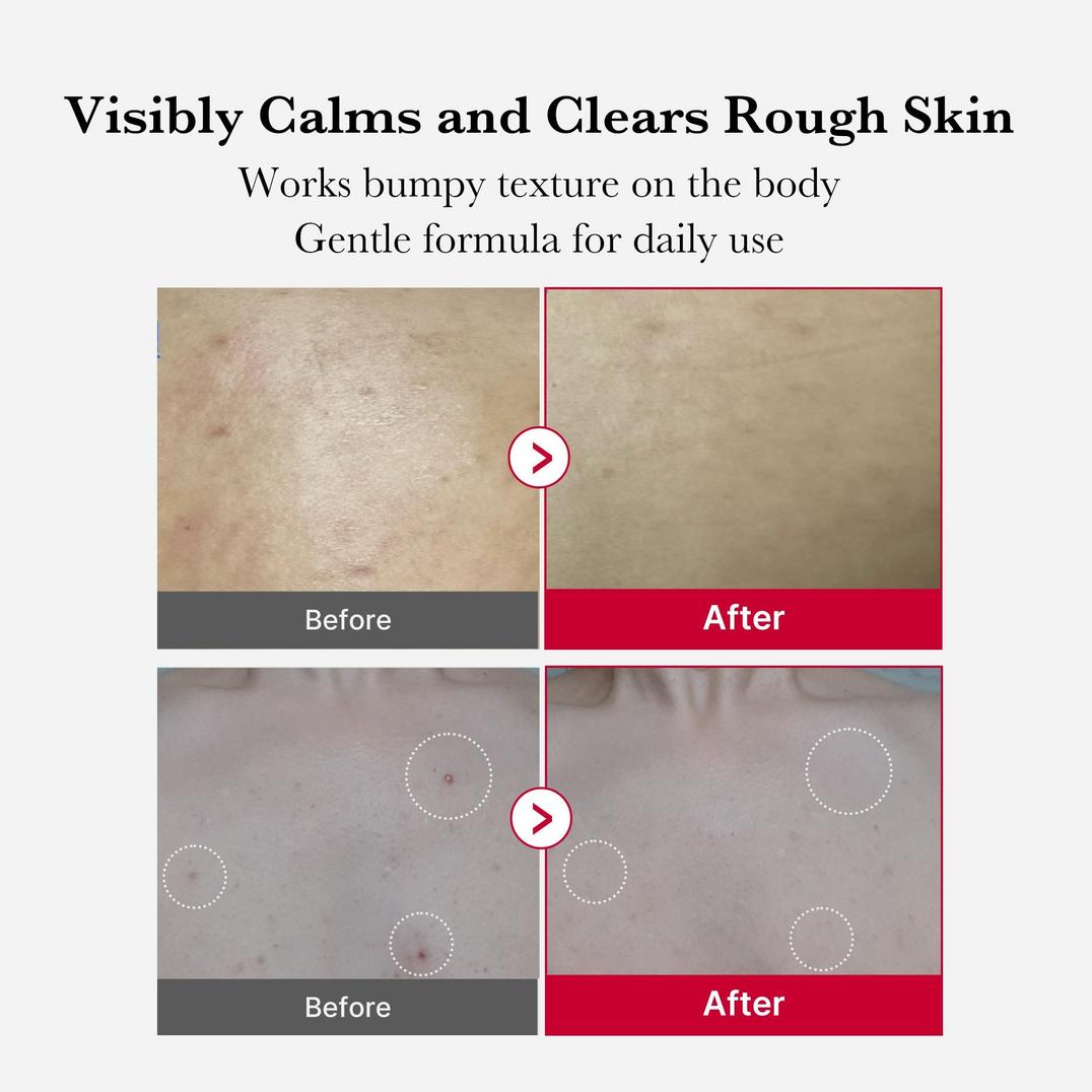 medicube Red Acne Body Peeling Shot