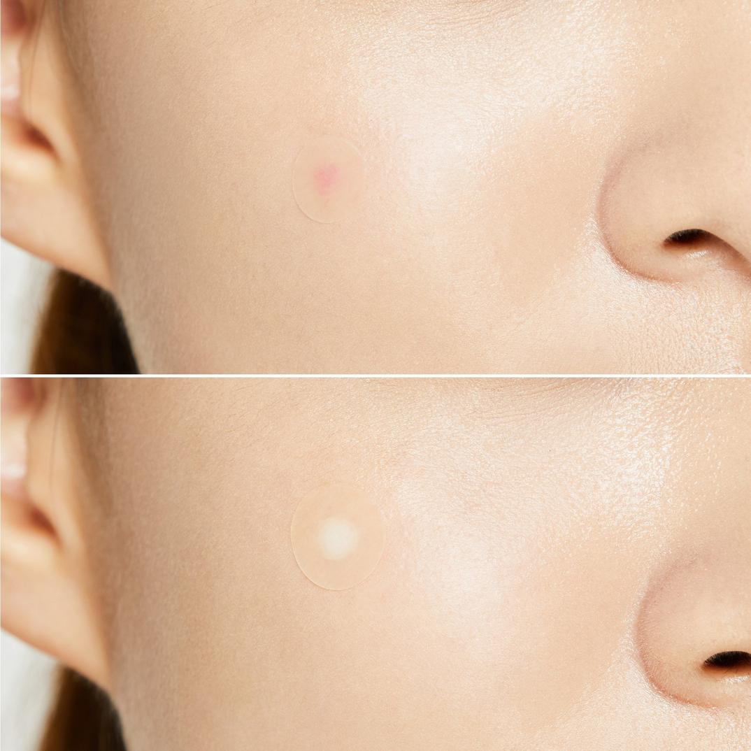 COSRX Master Patch Hydrocolloid Patches Set