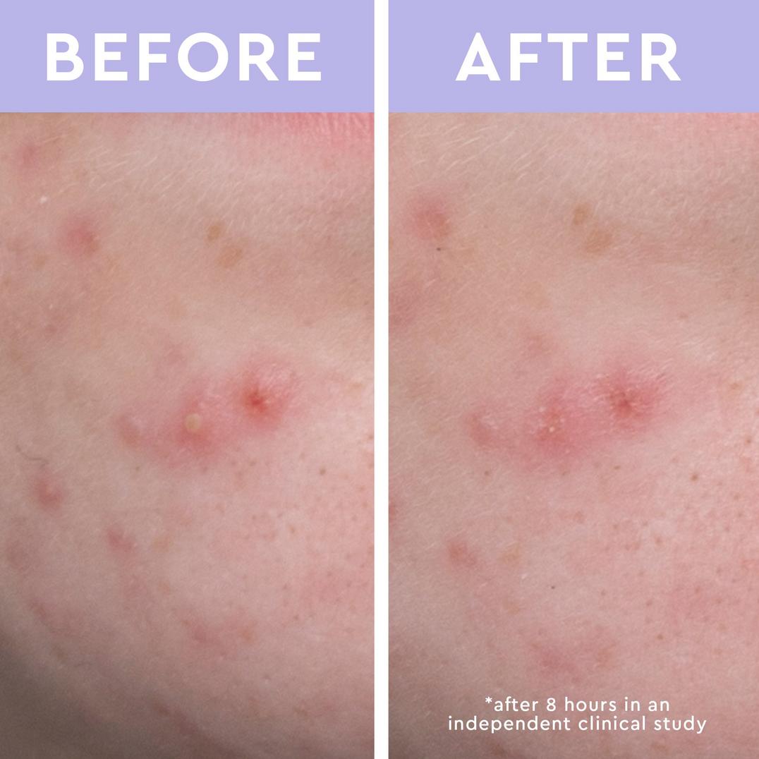 florence by mills Spot a Spot Acne Patches