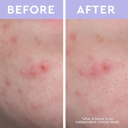 florence by mills Spot a Spot Acne Patches