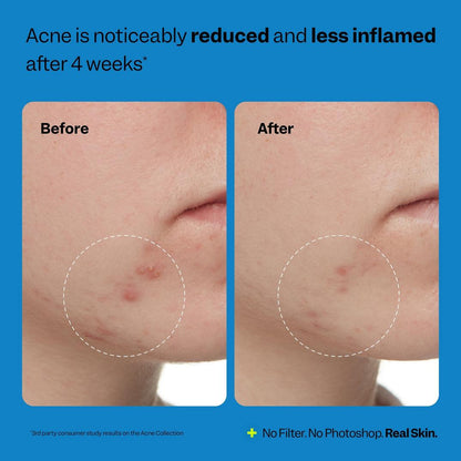 Peach Slices Acne Exfoliating Toner