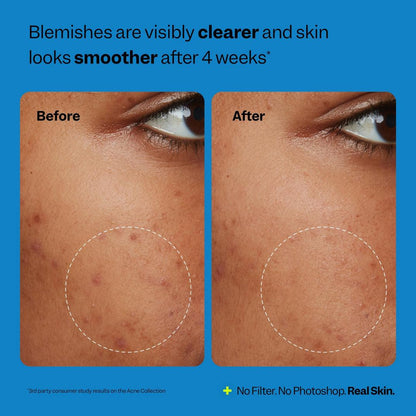 Peach Slices Acne Oil-Free Moisturizer