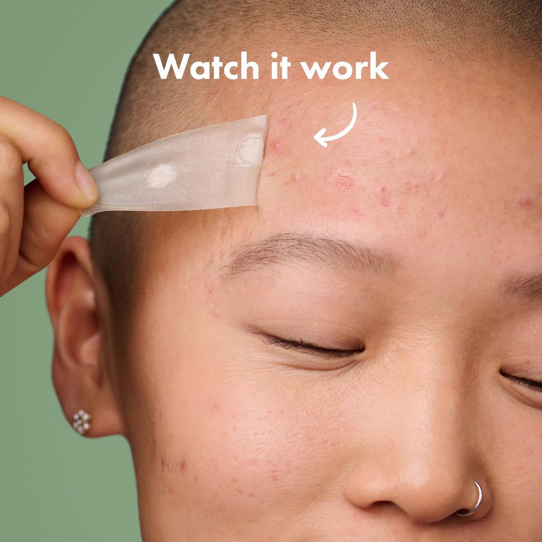 Hero Cosmetics Mighty Patch Surface Acne Pimple Patches