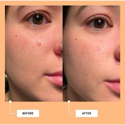 good light Luna Fast Acting Pimple Patches