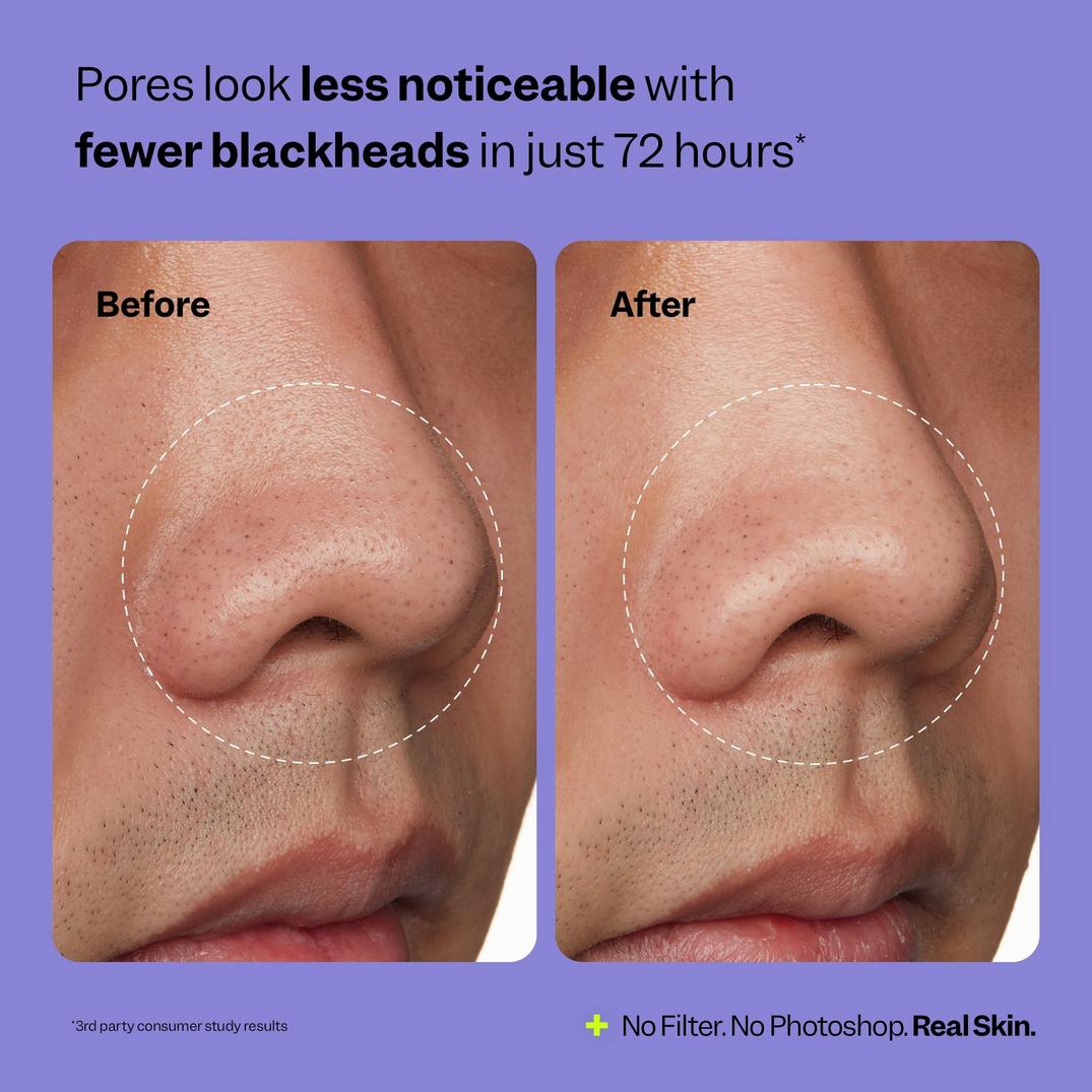 Peach Slices Nose Pore Patches
