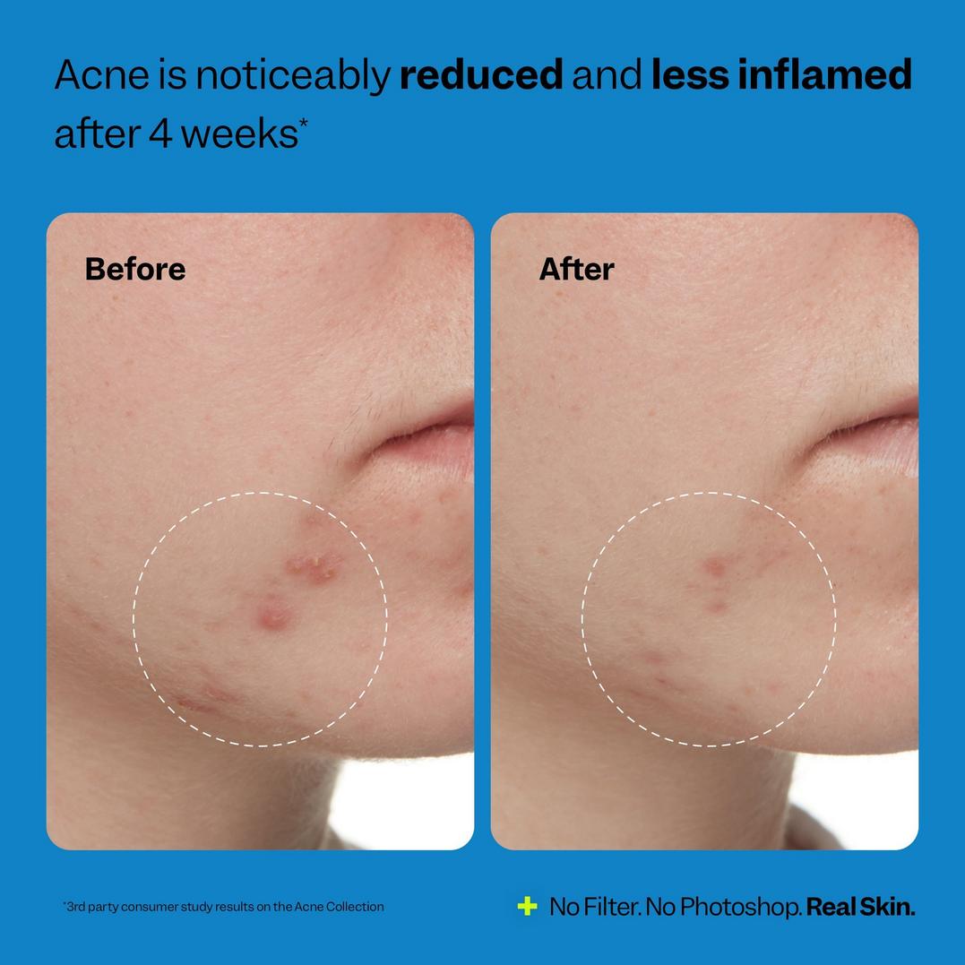 Peach Slices 3-Step Acne Starter Kit