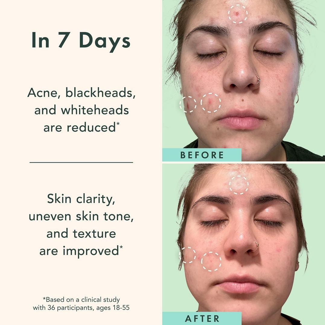 Rael Miracle Clear Complete Acne Serum