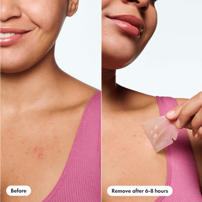 Hero Cosmetics Mighty Patch Body Acne Pimple Patches