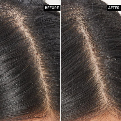 The INKEY List Salicylic Acid Exfoliating Oily Scalp Treatment