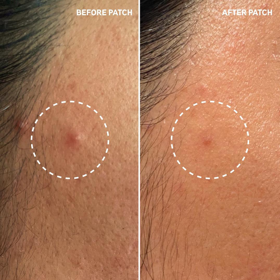 The INKEY List Hydrocolloid Invisible Pimple Patches + Salicylic Acid