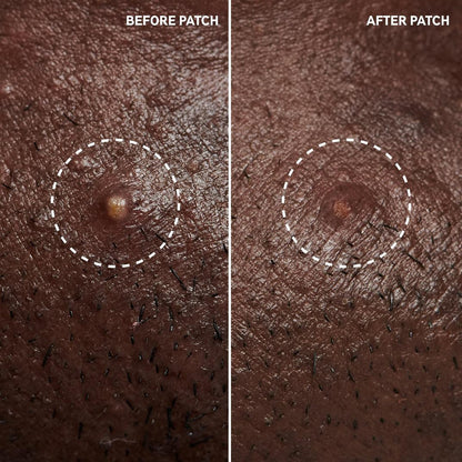 The INKEY List Hydrocolloid Invisible Pimple Patches + Salicylic Acid