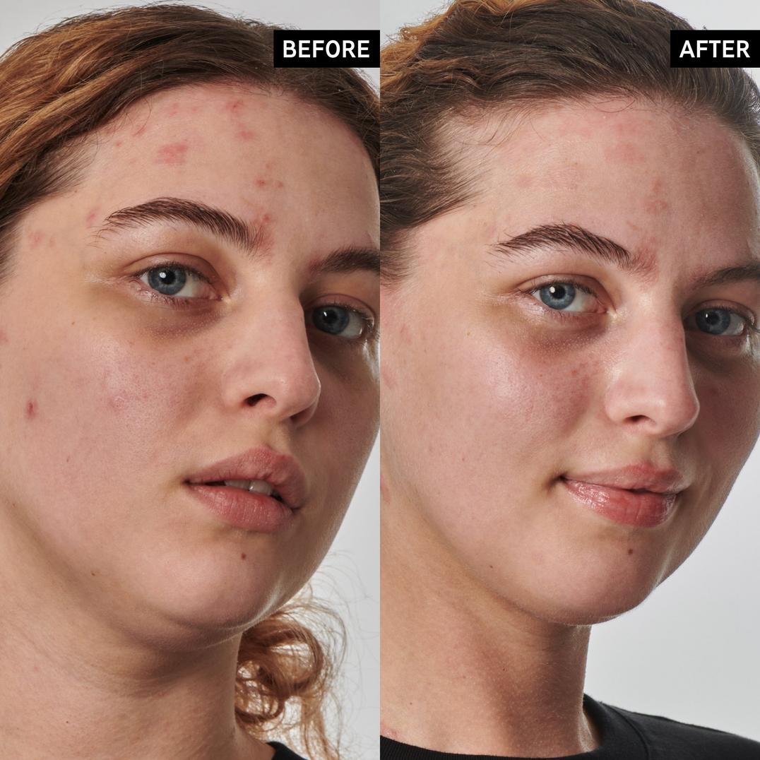 INKEY SuperSolutions 10% Urea Moisturizer Textured Skin Solution