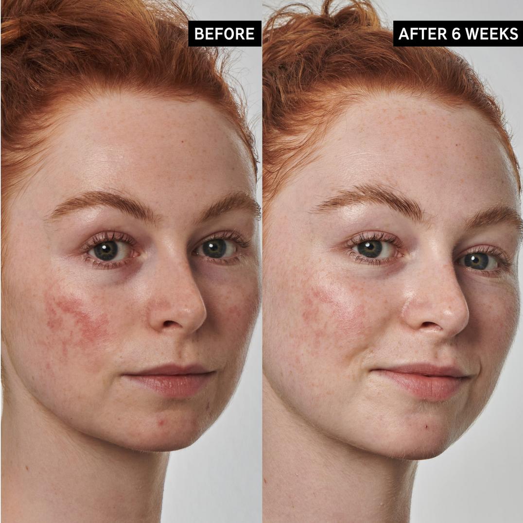 INKEY SuperSolutions 10% Azelaic Acid Serum Redness Relief Solution
