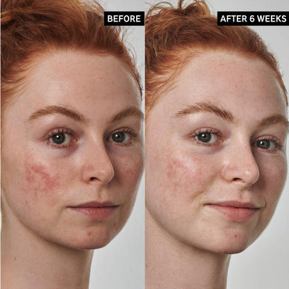 INKEY SuperSolutions 10% Azelaic Acid Serum Redness Relief Solution