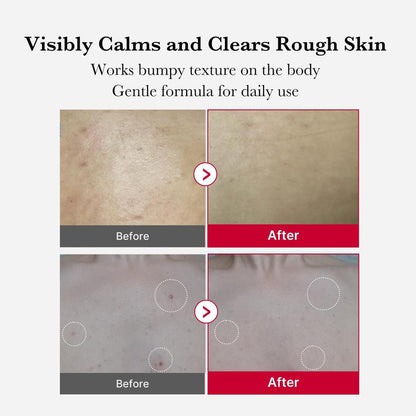 medicube Red Acne Body Peeling Shot